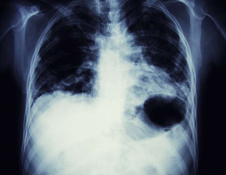 lungcancer