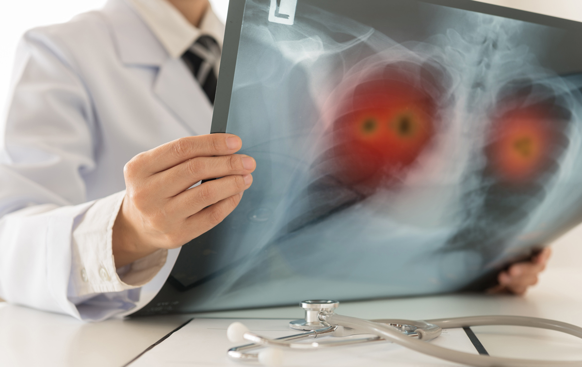 Why are patients with lung cancer living longer